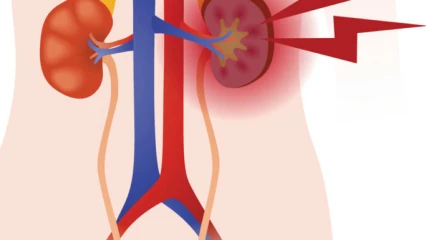 INSUFFISANCE RENALE : Tout sur une tueuse silencieuse