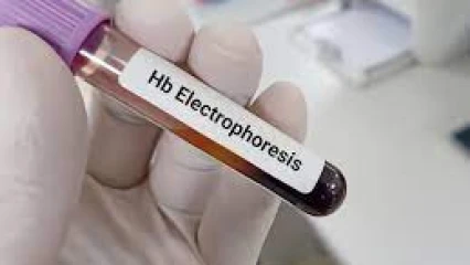 SANTÉ : La nécessité du test d&rsquo;électrophorèse avant le mariage