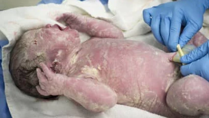SANTE : Vernix caseosa, un liquide protecteur du nouveau-né