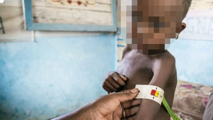 MALNUTRITION : Une maladie méconnue avec de graves conséquences sur la santé