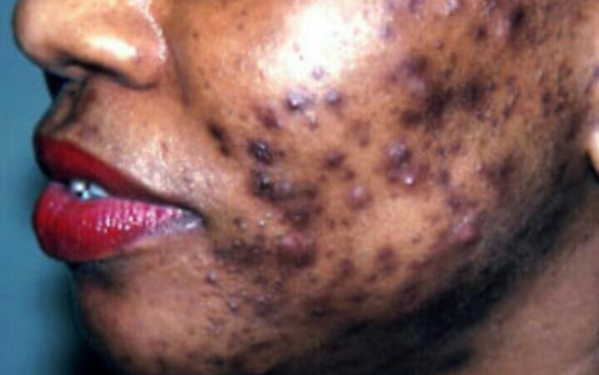 DEPIGMENTATION : Un phénomène à la peau  dure