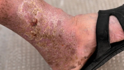 Recrudescence des cas d&rsquo;ulcération de jambes dans certaines localités du Bénin: Les victimes invitées à se référer aux hôpitaux spécialisés 