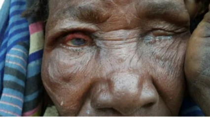 TRACHOME   : L’une des causes de cécité dans le monde