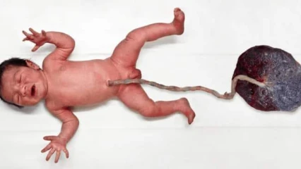 COUPURE SYSTÉMATIQUE DU CORDON OMBILICAL APRES ACCOUCHEMENT À LA MATERNITÉ : Ce que cache la spontanéité des agents de santé dans le processus