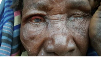 TRACHOME   : L’une des causes de cécité dans le monde