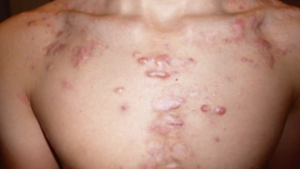 SANTÉ : Ce qu’il faut savoir sur les chéloïdes