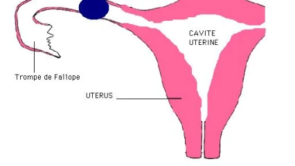 GROSSESSE EXTRA-UTERINE : Un phénomène méconnu, cause de nombreuses mortalités maternelles