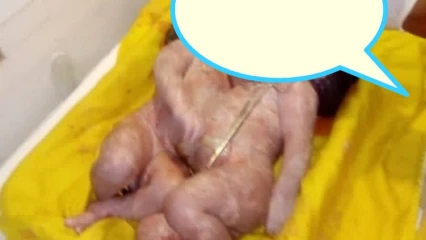 BENIN/ ACCOUCHEMENT DE BEBE SIAMOIS: Le père lance un Sos au gouvernement  ( Lire sa lettre ouverte au ministre des affaires sociales et de la microfinance)