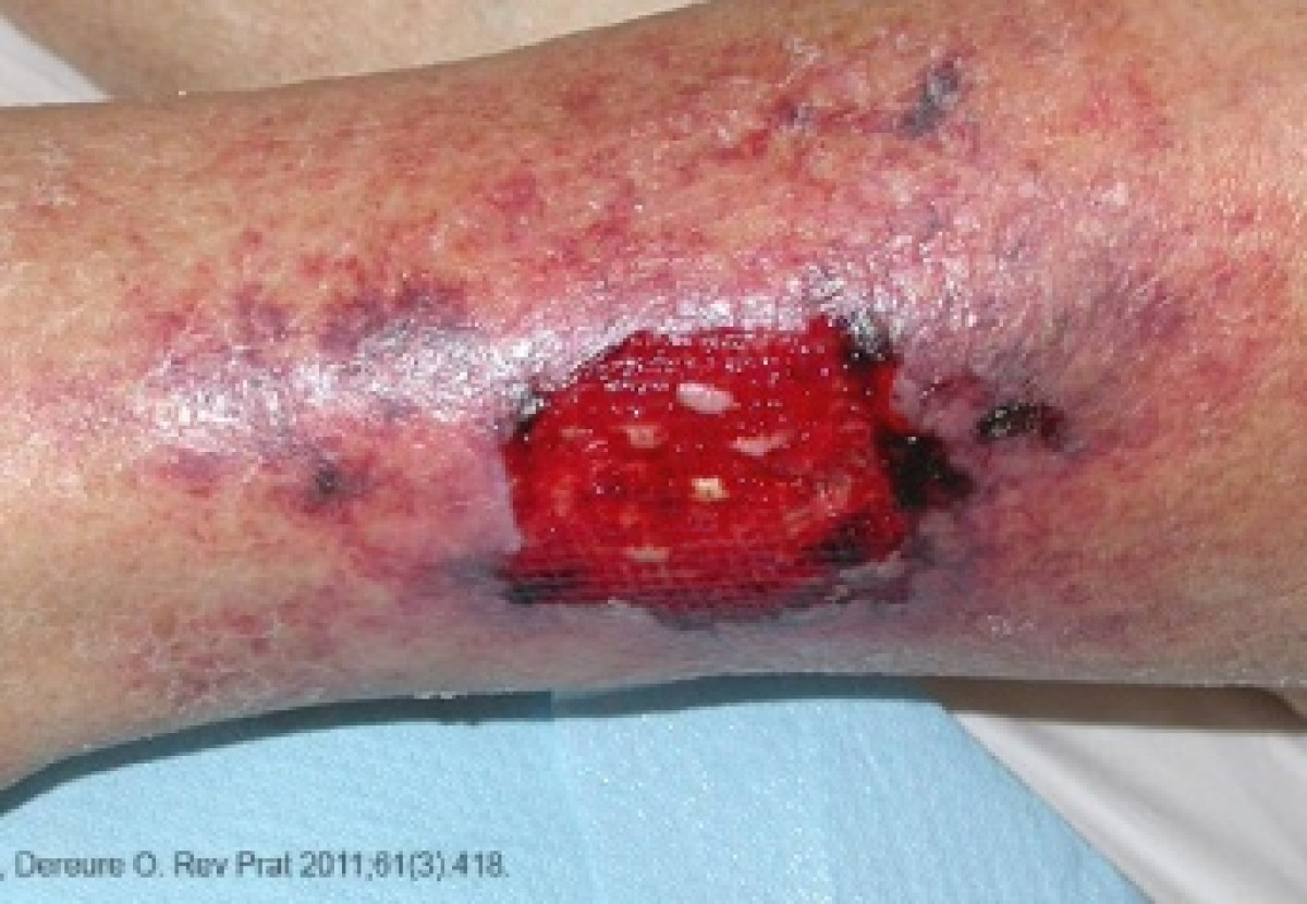 Au profit des personnes souffrant de plaies chroniques au Bénin: Des consultations gratuites lancées sur tout le territoire