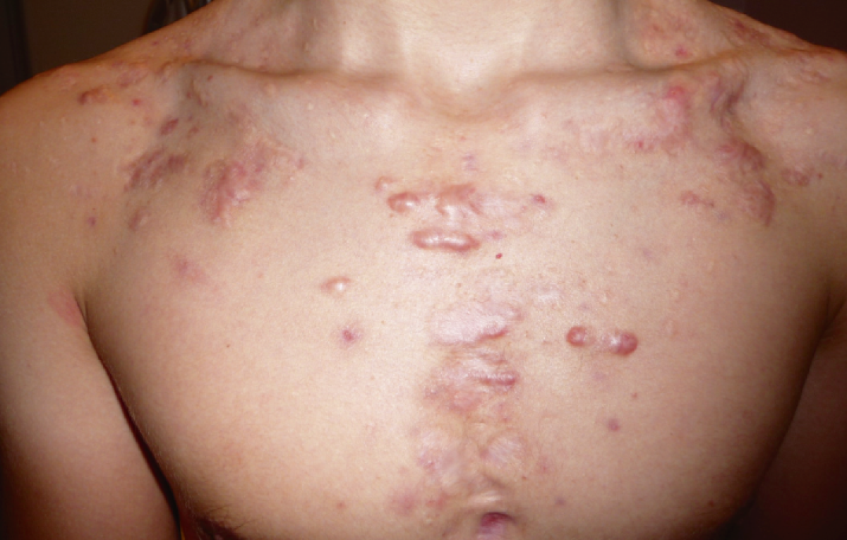 SANTÉ : Ce qu’il faut savoir sur les chéloïdes