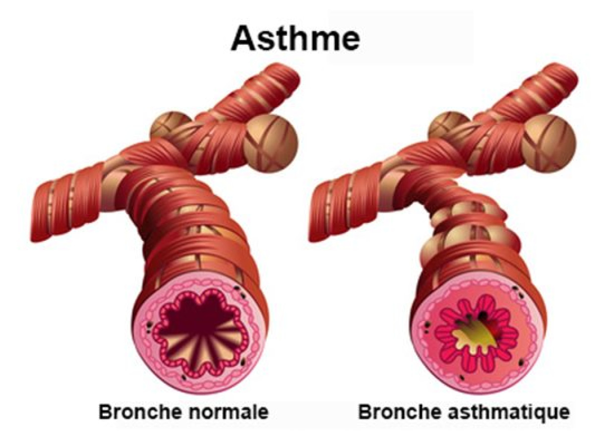 SANTE : Tout sur l&rsquo;Asthme