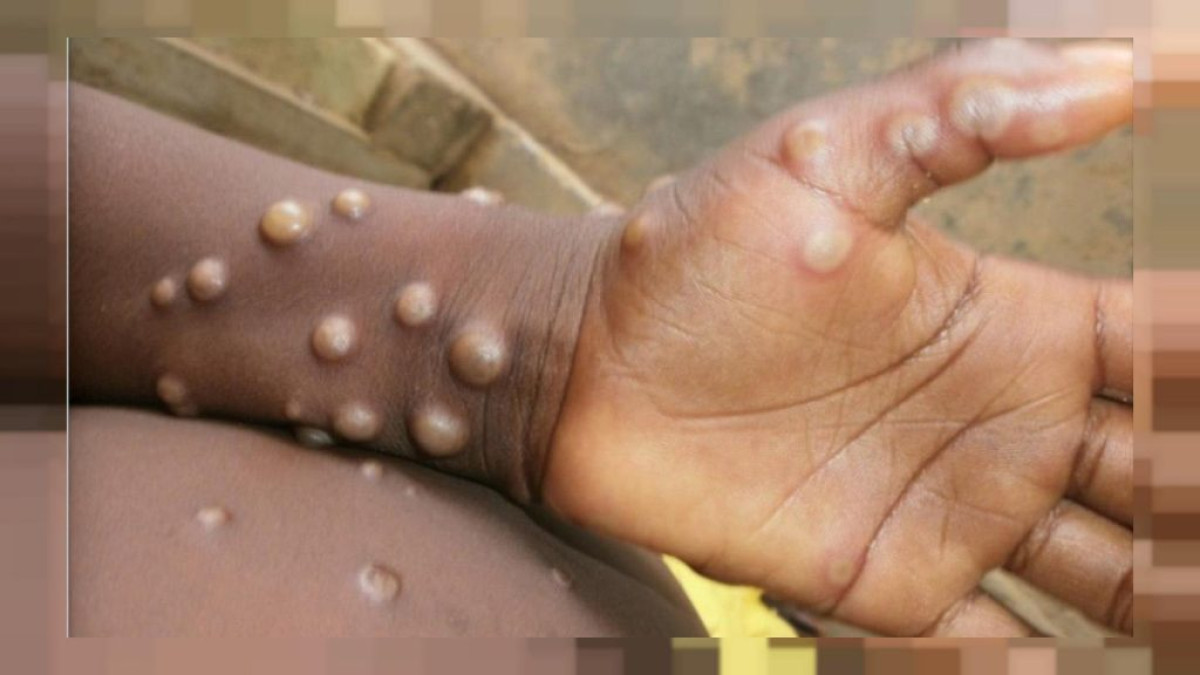 VARIOLE DU SINGE : Ce qu’il faut savoir de cette nouvelle maladie qui sévit au Bénin