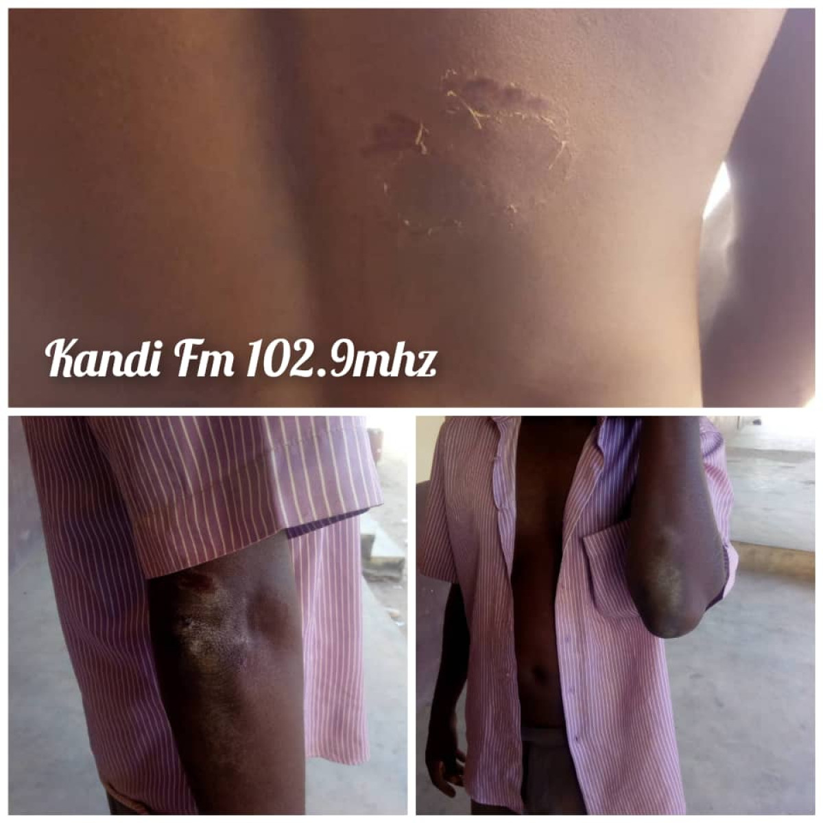 FAIT DIVERS À KANDI : Un censeur se fait mordre au dos par l’épouse d’un ancien vacataire