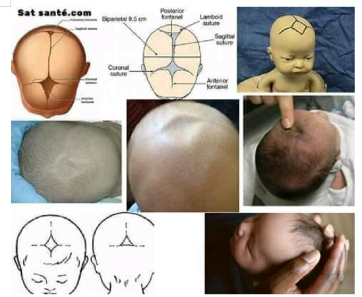 SANTE DES NOUVEAUX NES  : Tout sur la fontanelle