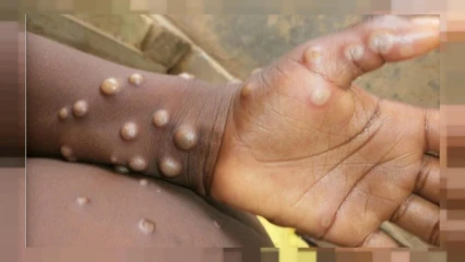 VARIOLE DU SINGE : Ce qu&rsquo;il faut savoir de cette nouvelle maladie qui sévit au Bénin