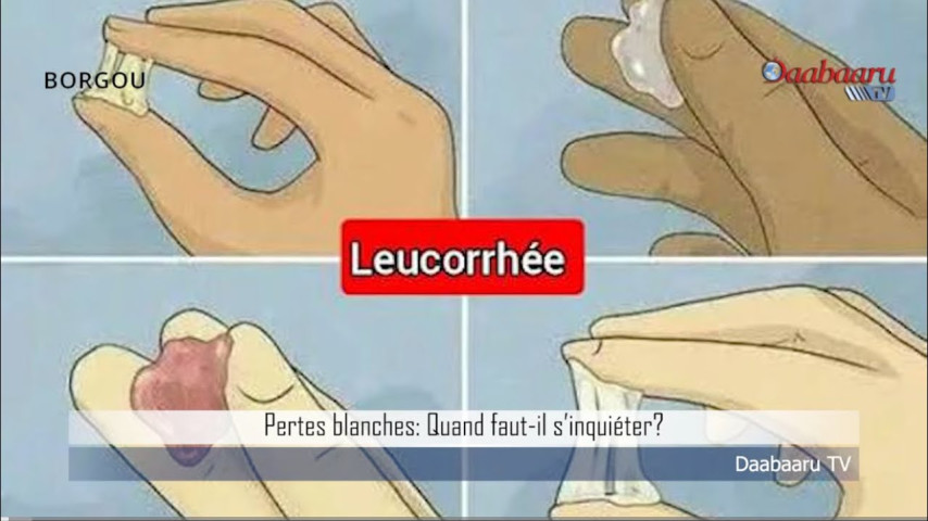 PERTES BLANCHES: Quand faut-il s'inquiéter?